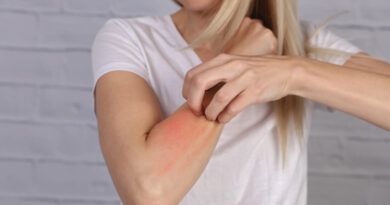 blonde woman with allergic reaction on hand