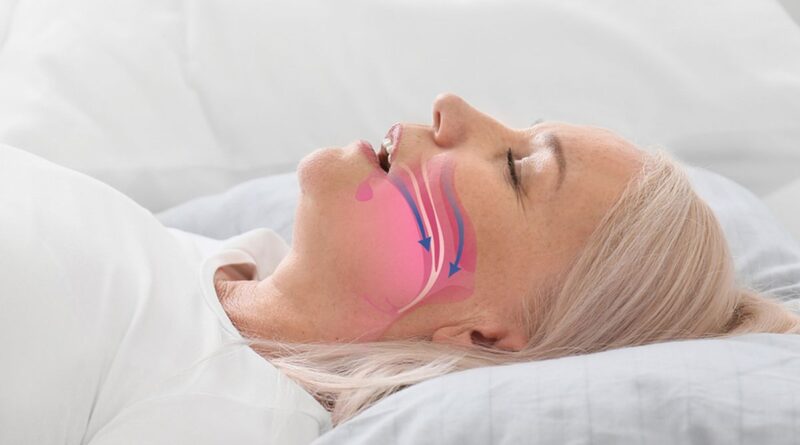sleep apnea